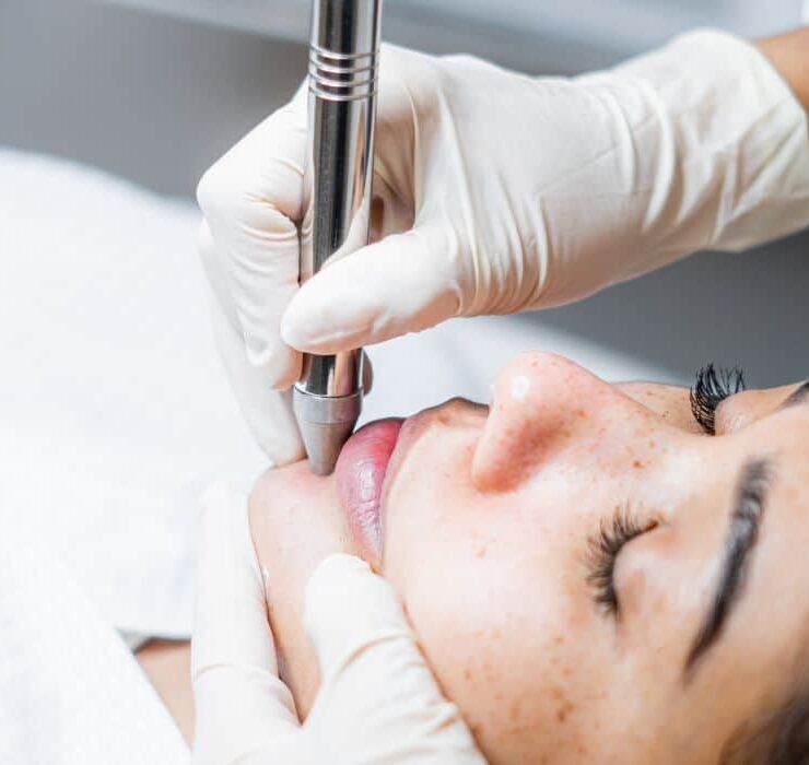 mh_skin_dermatology_sp_nomedoservico_limpeza_de_pele_por_succao.jpg